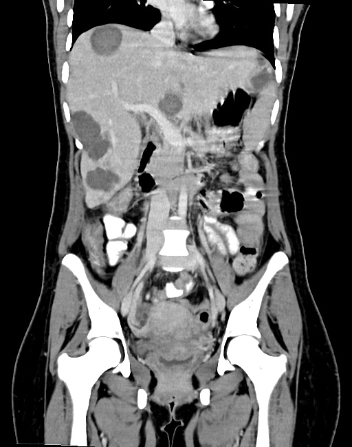 Choriocarcinoma liver metastases (Radiopaedia 74768-85766 B 52).jpg