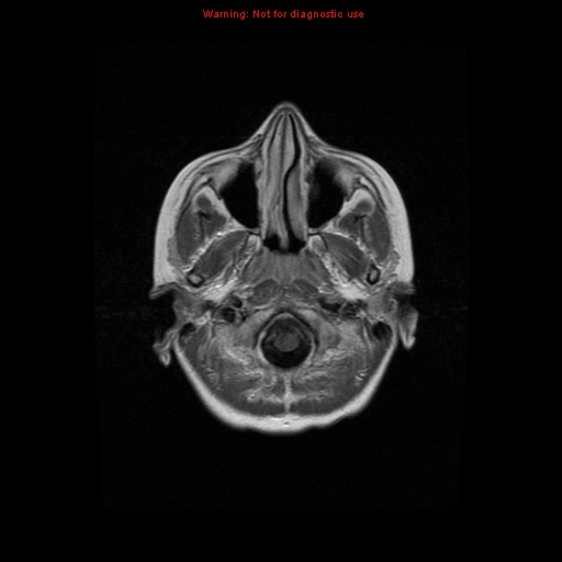 File:Choroid plexus carcinoma - recurrent (Radiopaedia 8330-9169 Axial T1 C+ 2).jpg