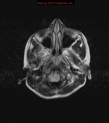 File:Choroid plexus papilloma (Radiopaedia 8466-9290 Axial FLAIR 1).jpg