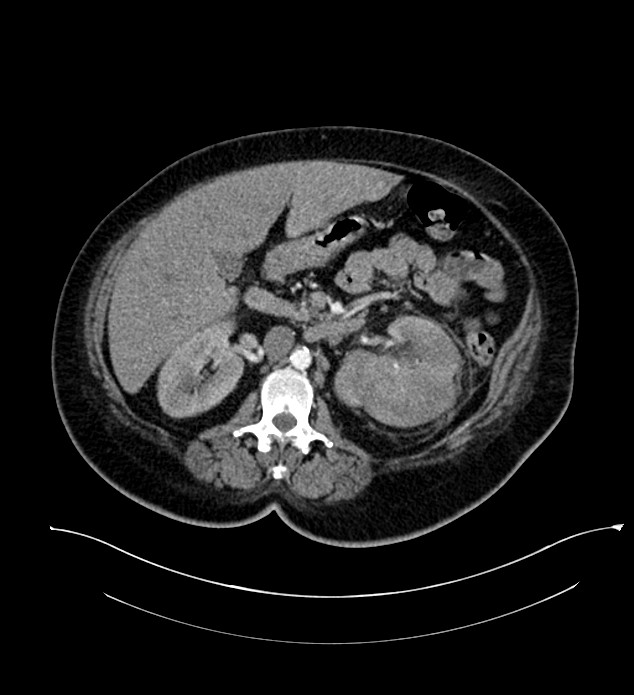 Chromophobe renal cell carcinoma (Radiopaedia 84239-99519 B 49).jpg