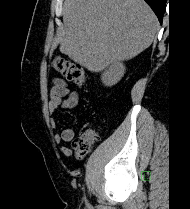 Chromophobe renal cell carcinoma (Radiopaedia 84286-99573 C 145).jpg