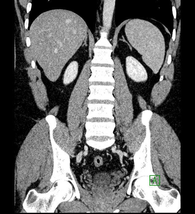 Chromophobe renal cell carcinoma (Radiopaedia 84286-99573 H 121).jpg
