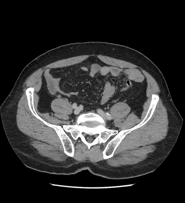 Chromophobe renal cell carcinoma (Radiopaedia 86879-103083 C 111).jpg