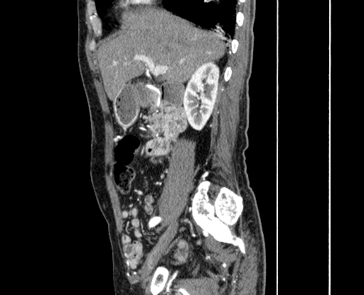 File:Chronic contained rupture of abdominal aortic aneurysm with extensive erosion of the vertebral bodies (Radiopaedia 55450-61901 B 4).jpg