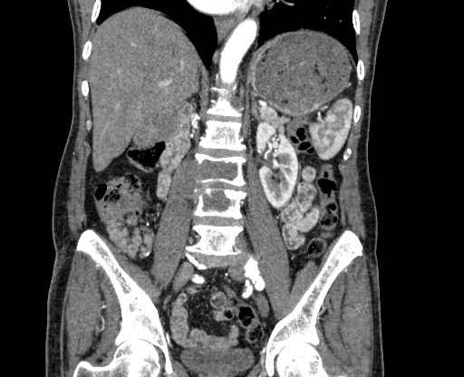 Chronic contained rupture of abdominal aortic aneurysm with extensive erosion of the vertebral bodies (Radiopaedia 55450-61901 D 44).jpg