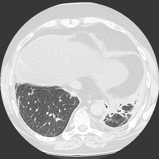 File:Chronic lung allograft dysfunction - restrictive form (Radiopaedia 60595-68316 Axial lung window 54).jpg