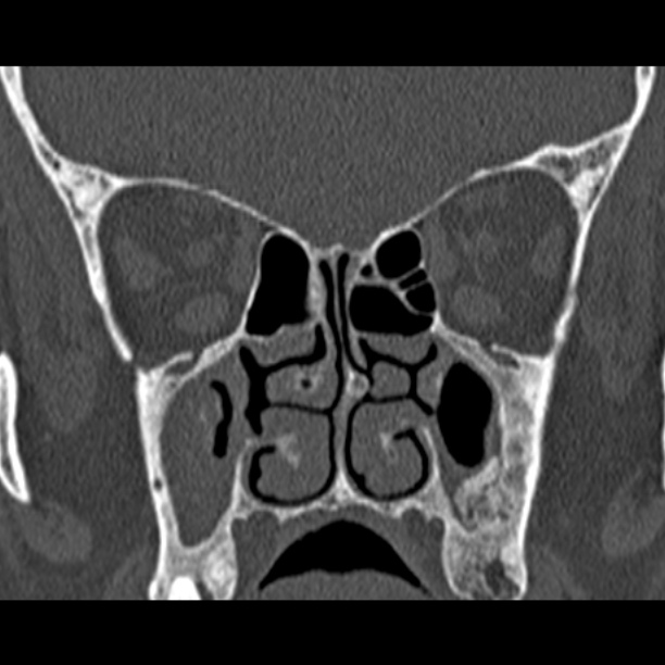 Chronic maxillary sinusitis (Radiopaedia 27879-28116 Coronal bone window 29).jpg