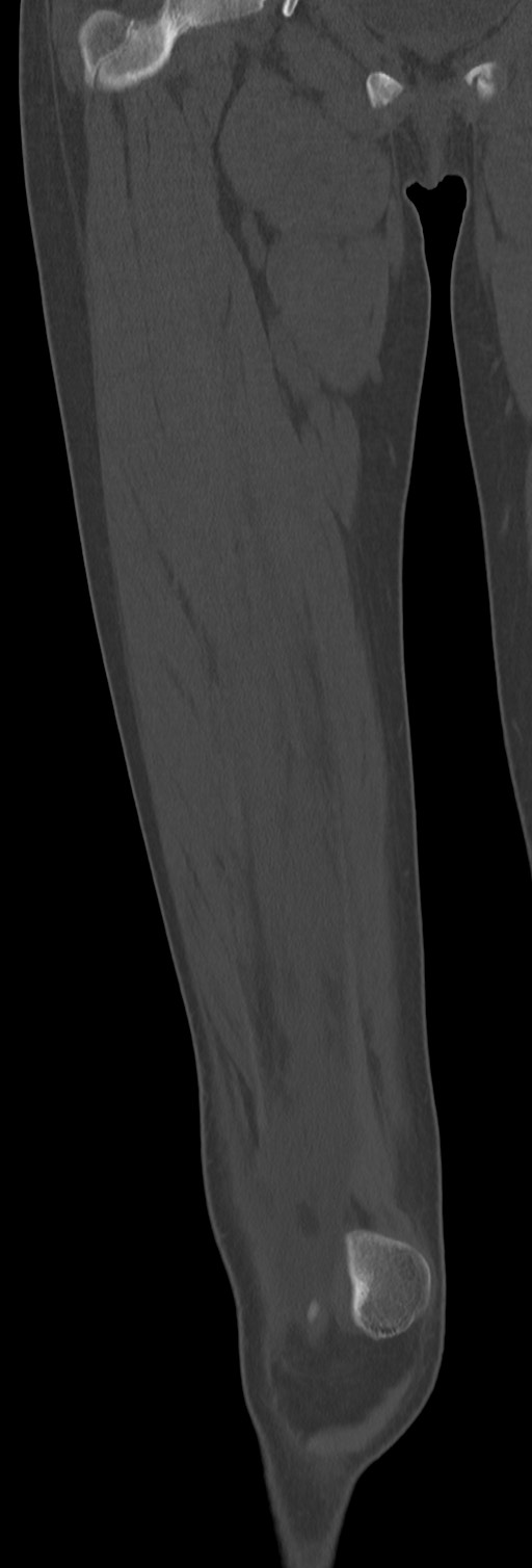 Chronic ostemyelitis of the femur with long sinus tract (Radiopaedia 74947-85982 Coronal bone window 30).jpg