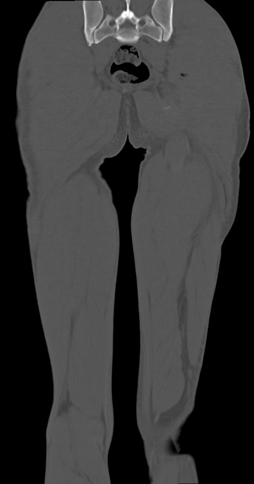 Chronic osteomyelitis (with sequestrum) (Radiopaedia 74813-85822 Coronal non-contrast 46).jpg