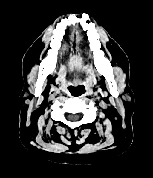 File:Chronic osteomyelitis - calvarial (severe) (Radiopaedia 69668-79616 Axial non-contrast 10).jpg