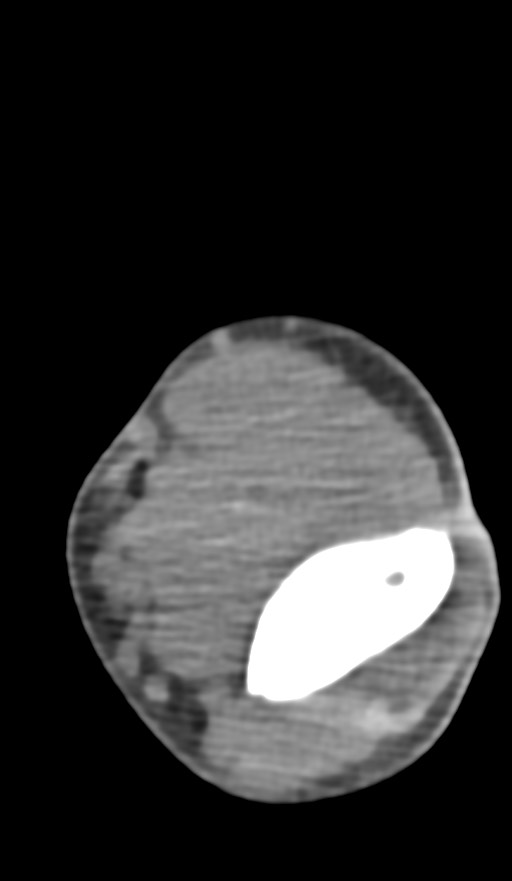 Chronic osteomyelitis of the distal humerus (Radiopaedia 78351-90971 Axial non-contrast 81).jpg