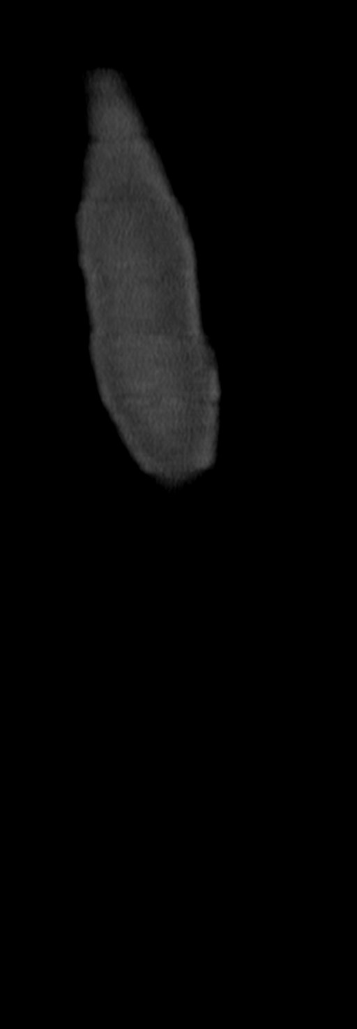 Chronic osteomyelitis of the distal humerus (Radiopaedia 78351-90971 Sagittal bone window 70).jpg