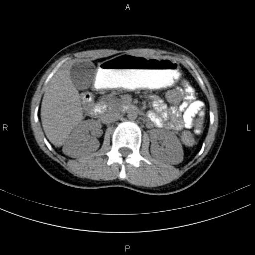 Chronic pancreatitis (Radiopaedia 64576-73450 Axial non-contrast 60).jpg