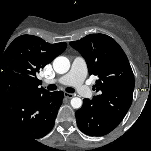 Chronic pulmonary embolism (Radiopaedia 73073-85094 Axial C+ CTPA 54).jpg