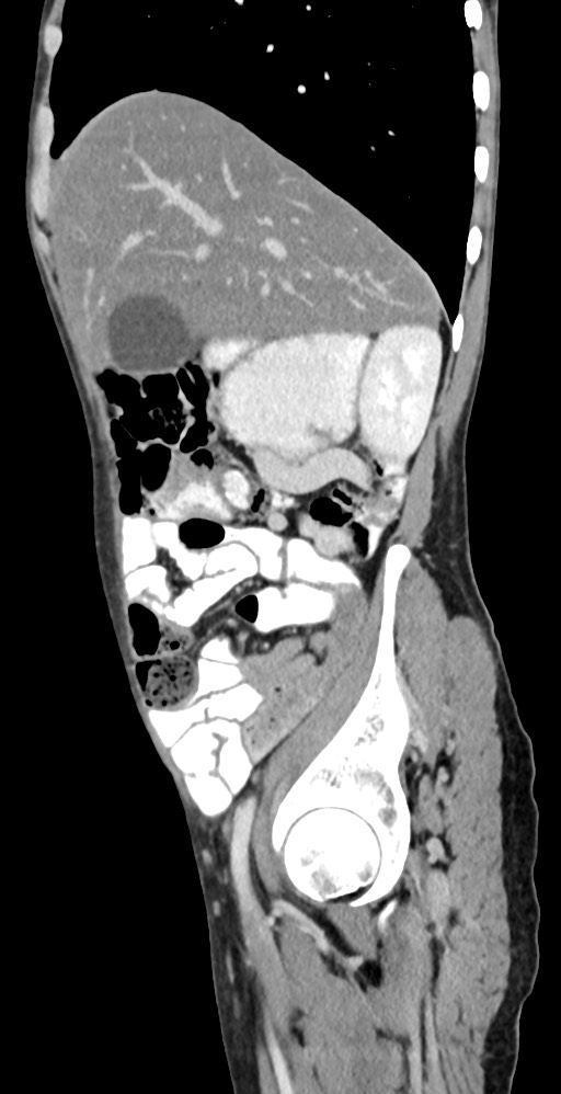 Chronic small bowel volvulus (Radiopaedia 75224-86322 C 108).jpg