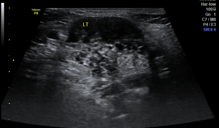 File:Chronic submandibular sialadenitis (Radiopaedia 61852-69883 B 1).png