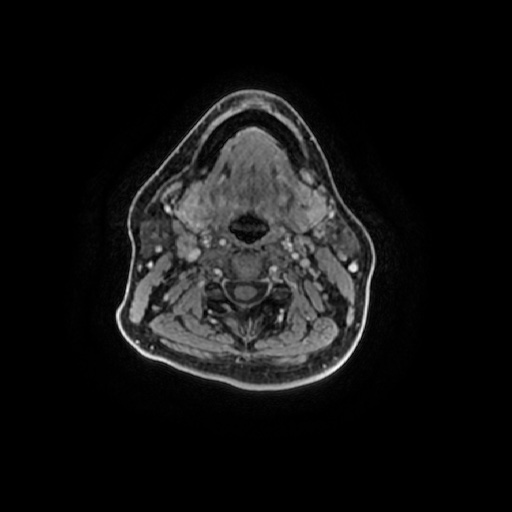 Chronic submandibular sialadenitis (Radiopaedia 61852-69885 Axial T1 C+ fat sat 55).jpg