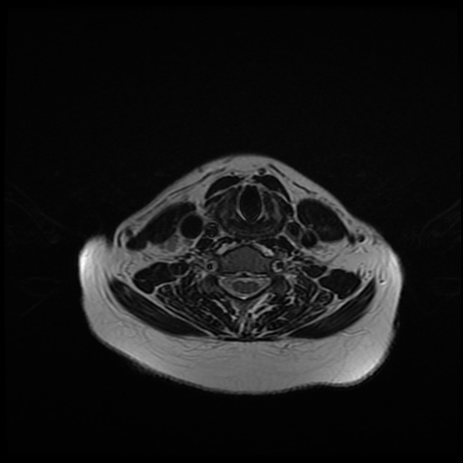 File:Chronic submandibular sialadenitis (Radiopaedia 61852-69885 Axial T2 22).jpg