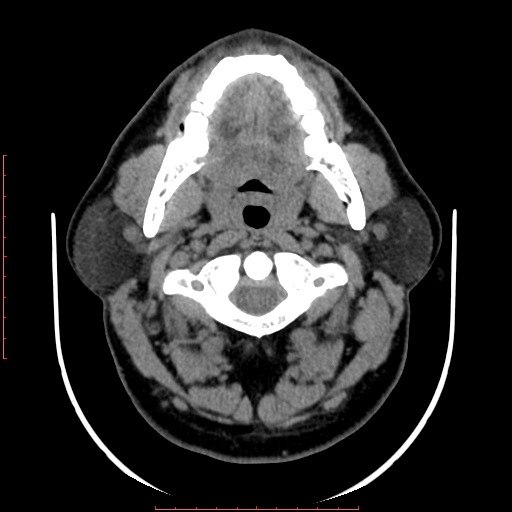 Chronic submandibular sialolithiasis (Radiopaedia 69817-79814 Axial non-contrast 69).jpg