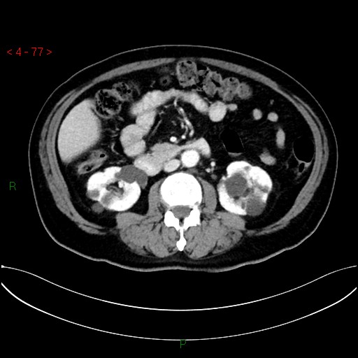 File:Circumaortic left renal vein and doubled left renal arteries (Radiopaedia 52268-58158 B 37).jpg