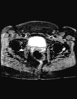 File:Class II Mullerian duct anomaly- unicornuate uterus with rudimentary horn and non-communicating cavity (Radiopaedia 39441-41755 Axial ADC 22).jpg