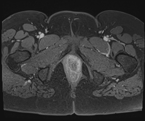 File:Class II Mullerian duct anomaly- unicornuate uterus with rudimentary horn and non-communicating cavity (Radiopaedia 39441-41755 Axial T1 fat sat 138).jpg