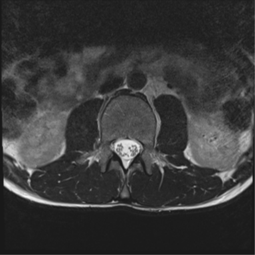File:Clear cell meningoma - lumbar spine (Radiopaedia 60116-67690 Axial T2 31).png