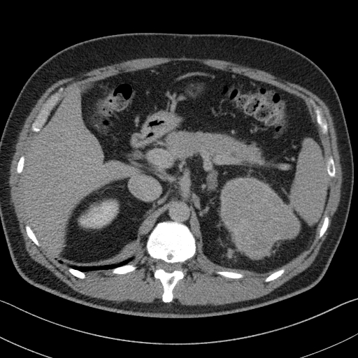 File:Clear cell renal cell carcinoma (Radiopaedia 61449-69393 H 15).jpg