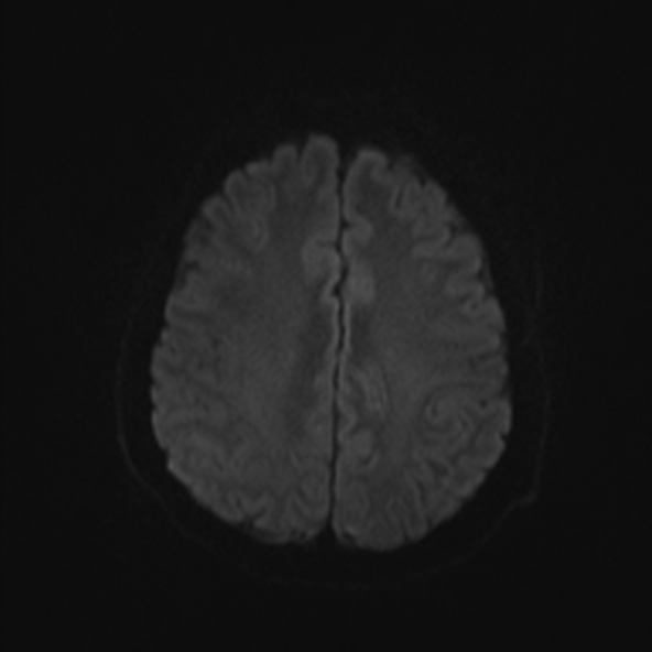 File:Clival meningioma (Radiopaedia 53278-59248 Axial DWI 43).jpg