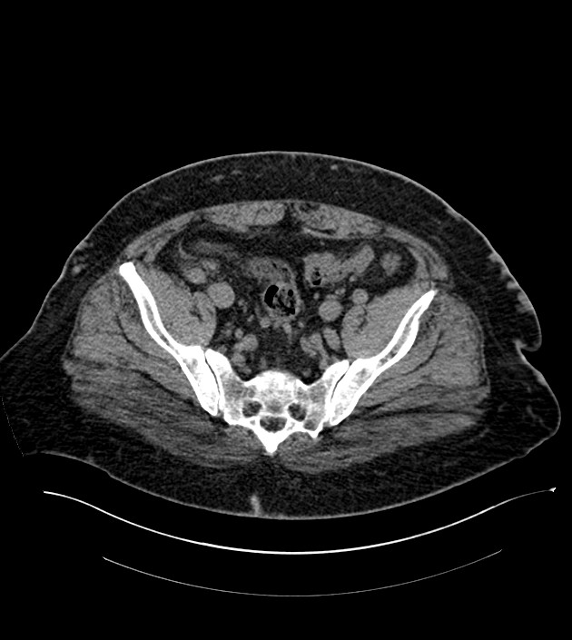 Closed-loop small bowel obstruction-internal hernia (Radiopaedia 78439-91096 Axial non-contrast 126).jpg
