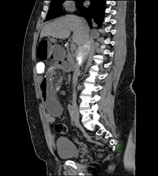 Closed-loop small bowel obstruction-internal hernia (Radiopaedia 78439-91096 C 84).jpg