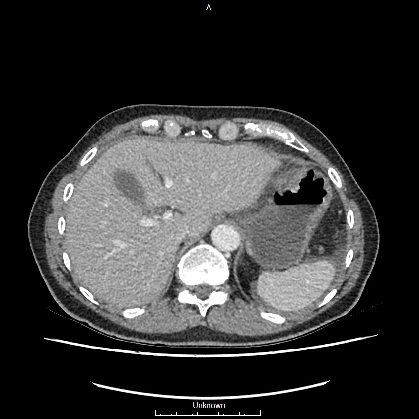 Closed loop bowel obstruction and ischemia (Radiopaedia 86959-103180 A 7).jpg