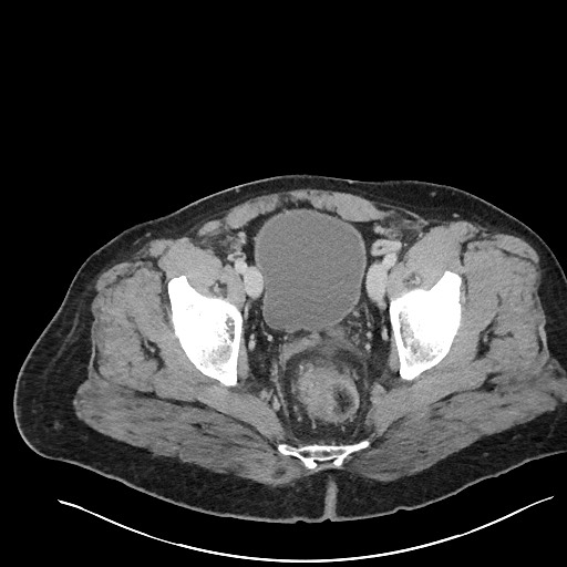 File:Closed loop obstruction - internal hernia into nephrectomy bed (Radiopaedia 59867-67320 A 129).jpg