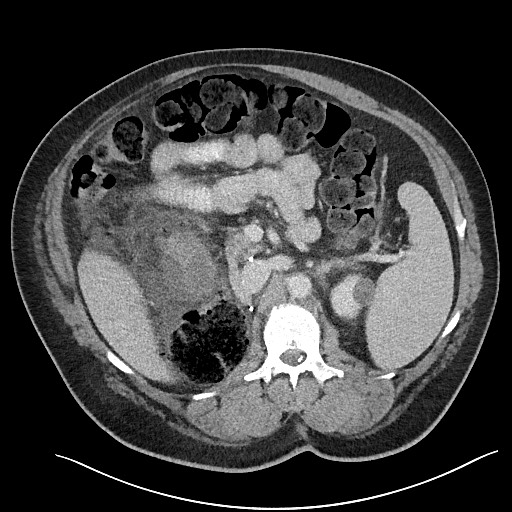 File:Closed loop obstruction - internal hernia into nephrectomy bed (Radiopaedia 59867-67320 A 50).jpg