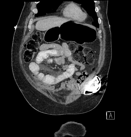 Closed loop obstruction - internal hernia into nephrectomy bed (Radiopaedia 59867-67320 B 22).jpg