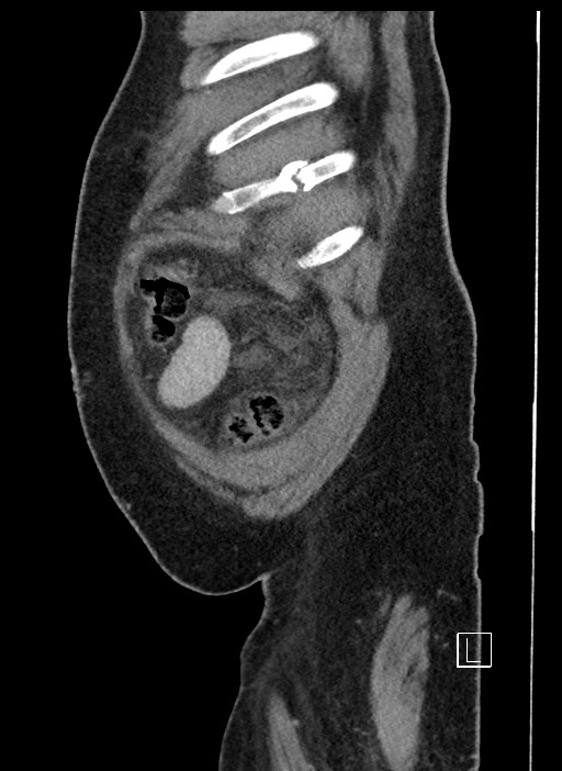 Closed loop obstruction - internal hernia into nephrectomy bed (Radiopaedia 59867-67320 C 103).jpg