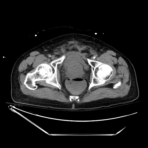 File:Closed loop obstruction due to adhesive band, resulting in small bowel ischemia and resection (Radiopaedia 83835-99023 Axial non-contrast 147).jpg