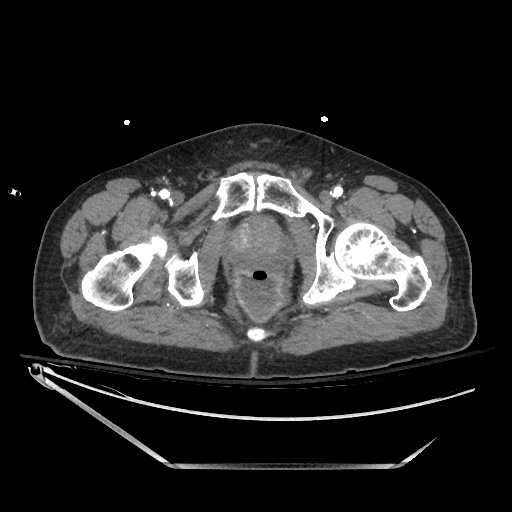 Closed loop obstruction due to adhesive band, resulting in small bowel ischemia and resection (Radiopaedia 83835-99023 B 153).jpg
