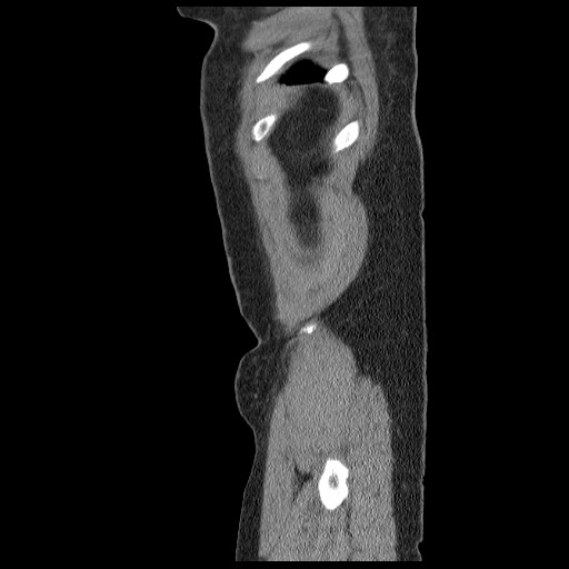 Closed loop small bowel obstruction (Radiopaedia 65403-74451 C 105).jpg