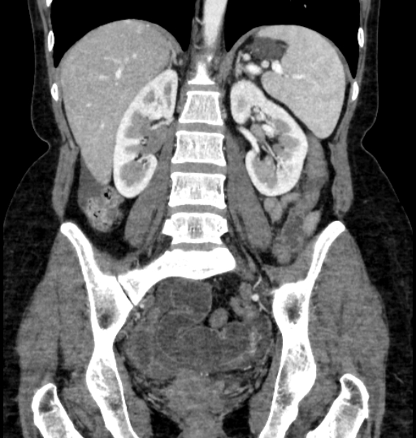 Closed loop small bowel obstruction (Radiopaedia 71211-81508 B 80).jpg