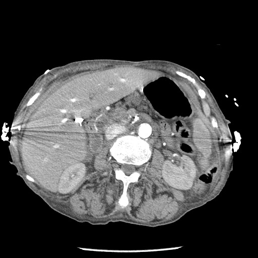 Closed loop small bowel obstruction - adhesions and infarct (Radiopaedia 85125-100678 A 70).jpg