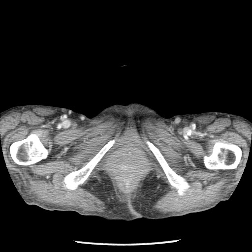 Closed loop small bowel obstruction - adhesions and infarct (Radiopaedia 85125-100678 B 118).jpg