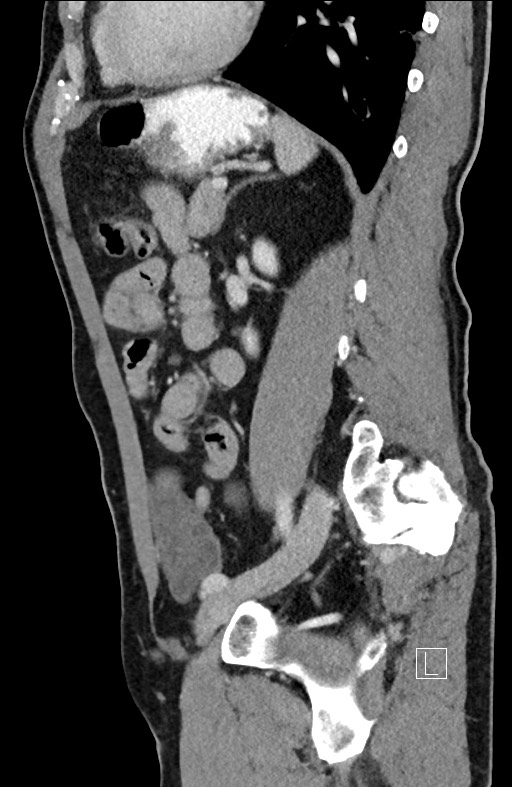 Closed loop small bowel obstruction - internal hernia (Radiopaedia 57806-64778 C 41).jpg
