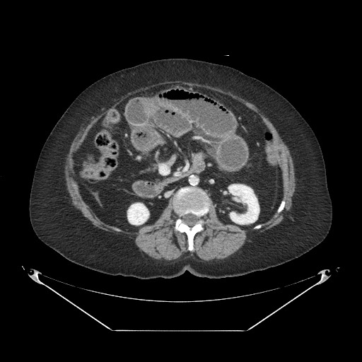 Closed loop small bowel obstruction - internal hernia (Radiopaedia 65402-74450 A 57).jpg