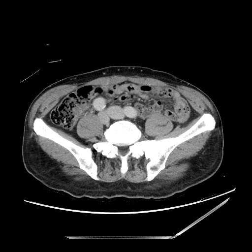 Closed loop small bowel obstruction - omental adhesion causing "internal hernia" (Radiopaedia 85129-100682 A 113).jpg