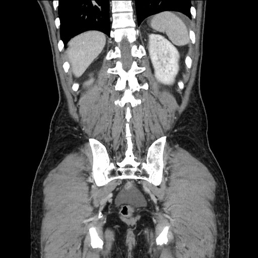 Closed loop small bowel obstruction - omental adhesion causing "internal hernia" (Radiopaedia 85129-100682 B 102).jpg