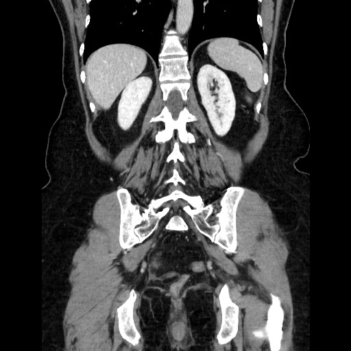 Closed loop small bowel obstruction due to adhesive bands - early and late images (Radiopaedia 83830-99015 B 91).jpg