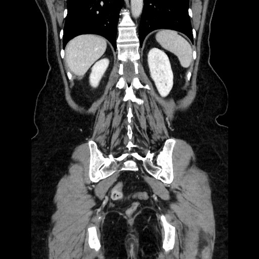 File:Closed loop small bowel obstruction due to adhesive bands - early and late images (Radiopaedia 83830-99015 B 94).jpg