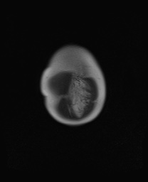 File:Closed loop small bowel obstruction in pregnancy (MRI) (Radiopaedia 87637-104031 Coronal T2 9).jpg