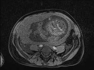 Closed loop small bowel obstruction in pregnancy (MRI) (Radiopaedia 87637-104031 F 24).jpg